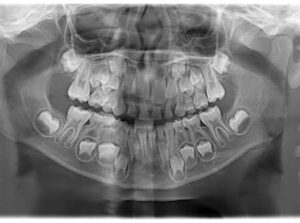 Dental xray